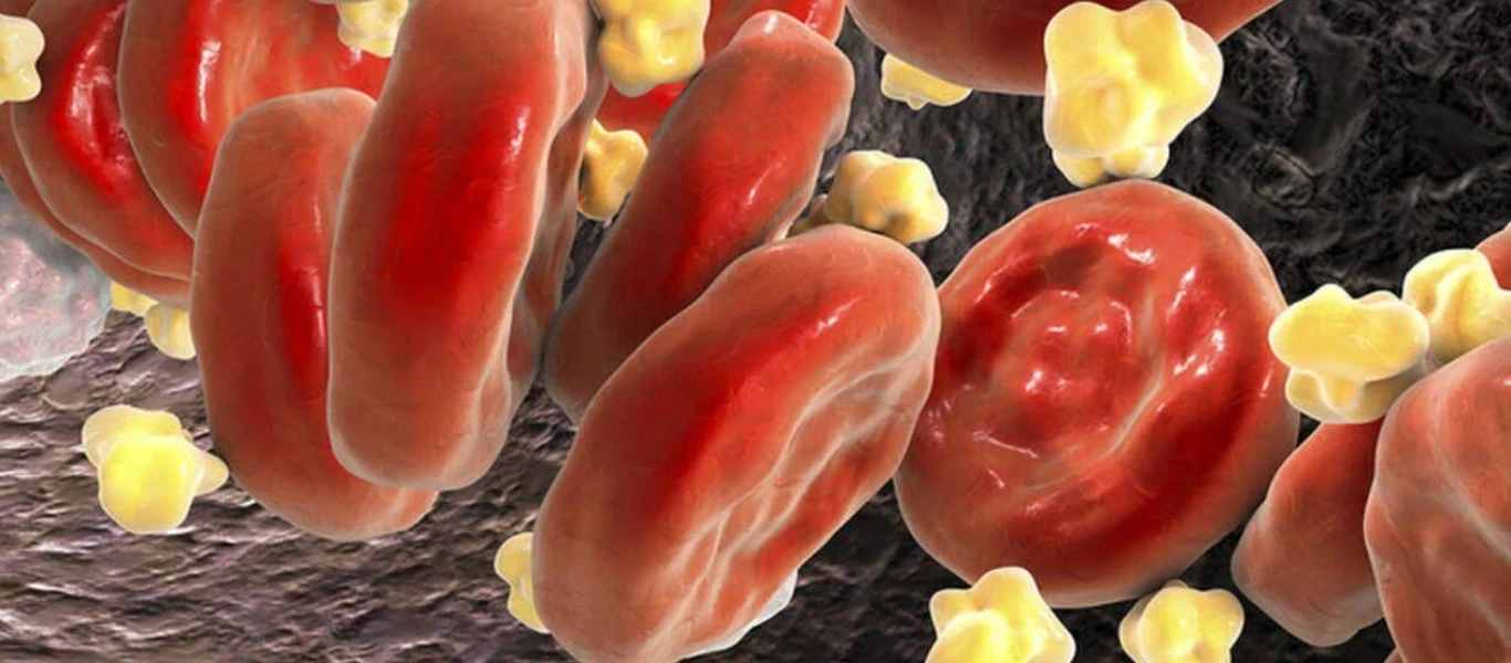 Με αυτά τα πέντε βήματα θα ρίξετε σίγουρα την υψηλή χοληστερόλη σας